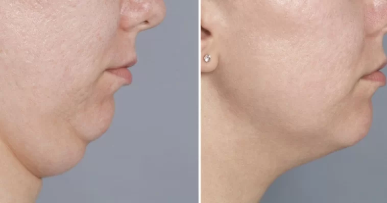 Double Chin Exercises: 5 Quick Moves to Firm Face in 30s