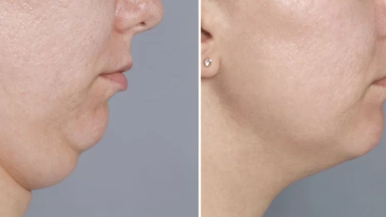 Double Chin Exercises: 5 Quick Moves to Firm Face in 30s